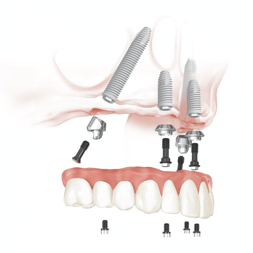 All on 4 procedure - Dental 359 Subiaco