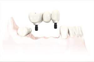 multiple implant - Dental 359