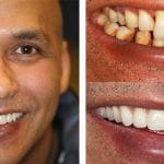 Dental Implant Before and After Dental 359 cosmetic dentistry Subiaco