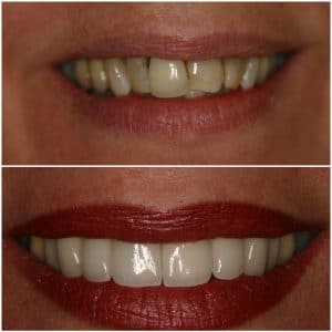 smile makeover before after at cosmetic dental clinic in subiaco