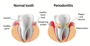 labelled image clearly showing periodontitis 
