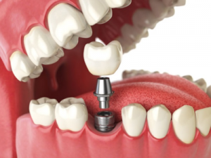 image clearly showing a single dental implant 