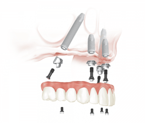 zoomed out image clearly showing a dental implant progress