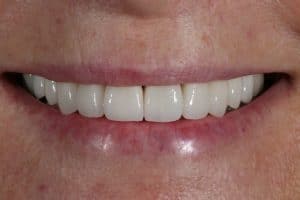 Teeth after porcelain veneers