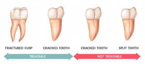 diagram showing fractured cusp cracked tooth and split tooth
