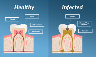 image clearly showing the differences between healthy and infected root canal