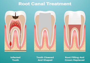 image explaining root canal treatment