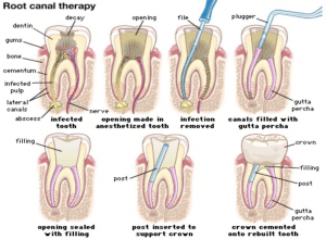 root canal therapy dental 359 detailed diagram