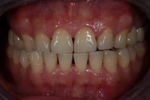 clear image showing Signs of Periodontal Disease